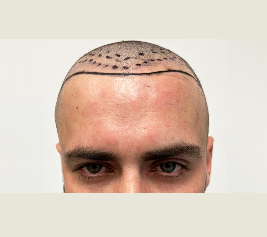 Przed zabiegiem